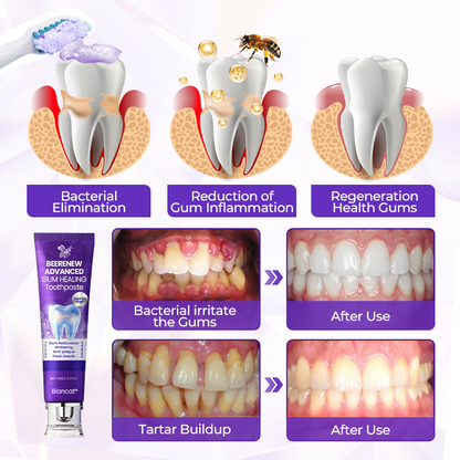 Biancat® BeeRenew Advanced Gum Healing Toothpaste✨（A）