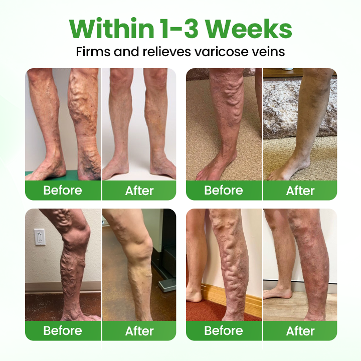 Healrize® VeinHeal Microneedle Patch ✨