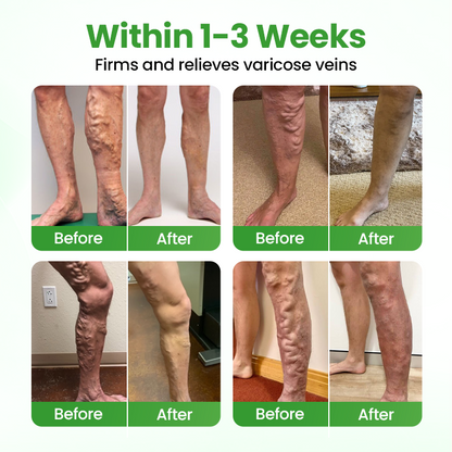 Healrize® VeinHeal Microneedle Patch ✨