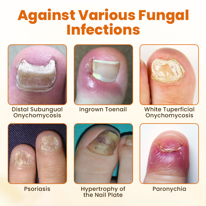 Timilk® FungiBee Advanced Nail Repair Spray ✨