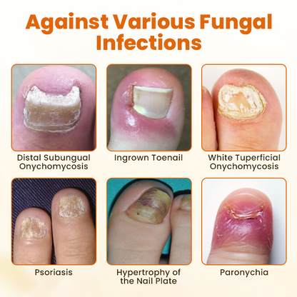 Timilk® FungiBee Advanced Nail Repair Spray ✨