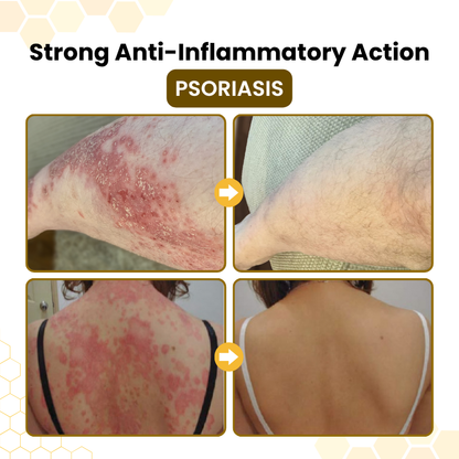 Timilk® PsoriaSoothe Bee Venom Skin-Restoration Cream🔥