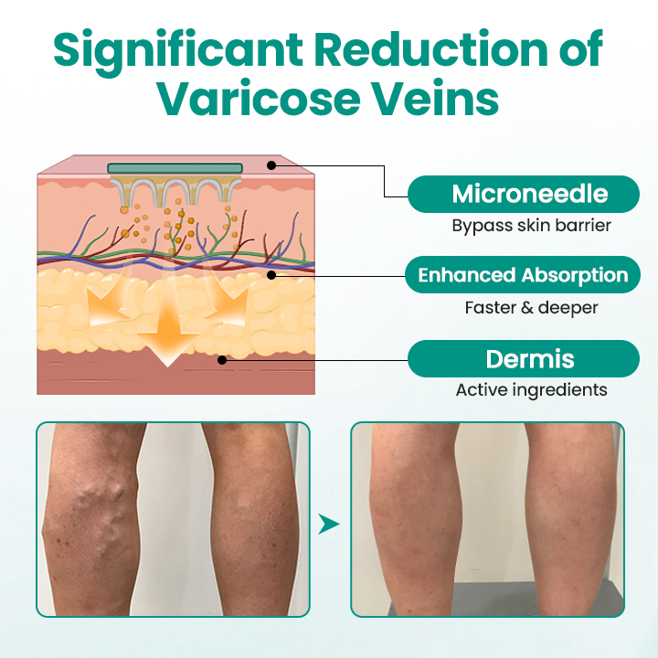 Timilk® LegRenew Varicose Veins Patch ✨