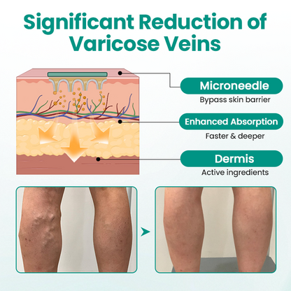 Timilk® LegRenew Varicose Veins Patch ✨