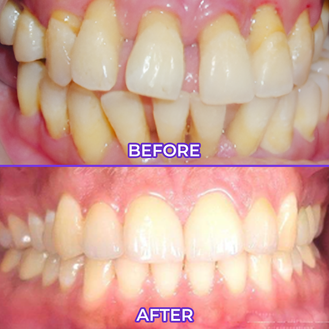 Biancat® SensiGum Fluoride Toothpaste🔥
