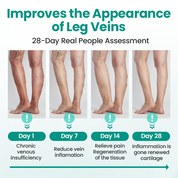 Timilk® LegRenew Varicose Veins Patch ✨