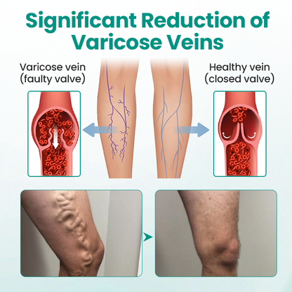 Timilk® LegRenew Varicose Veins Patch ✨